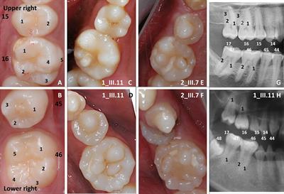 Genetic Evidence Supporting the Role of the Calcium Channel, CACNA1S, in Tooth Cusp and Root Patterning